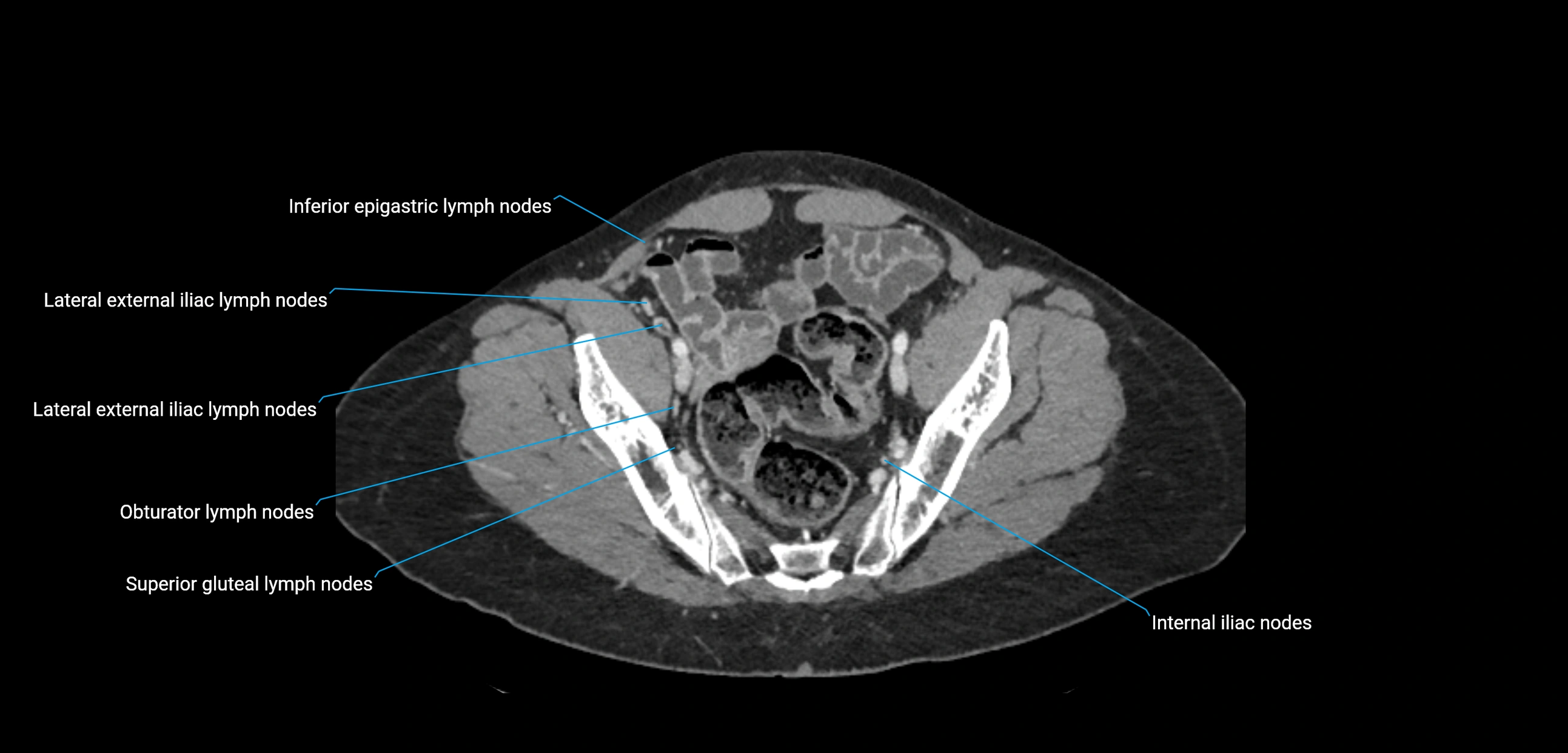 CT ct abdominal lymph nodes  axial cross sectional anatomy  enchanced radiology image -img-00002-00351.webp